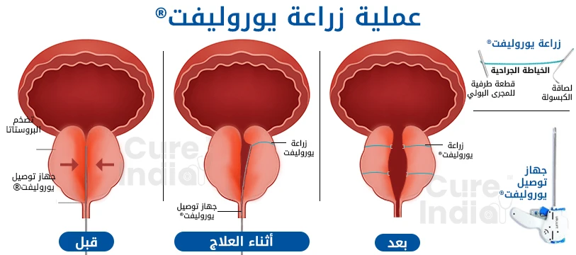 urolift لعلاج تضخم البروستاتا الحميد في الهند